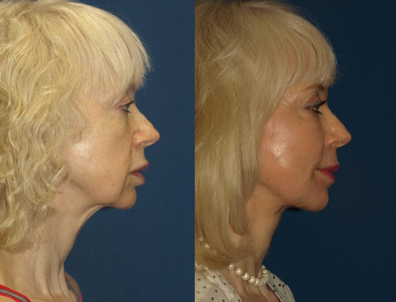 Cheek Implant Before and After Photos San Diego | David ...