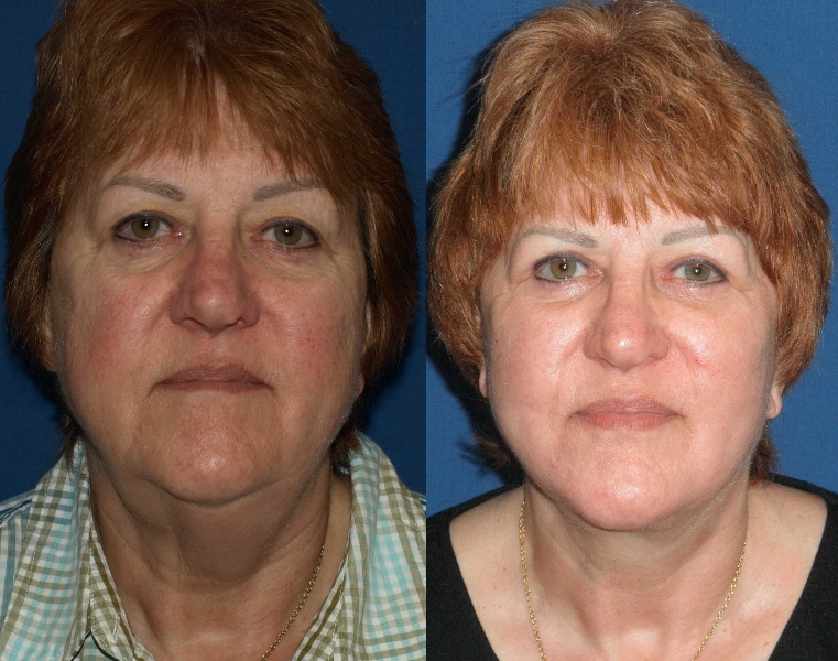 Facelift Before and After Photos San Diego