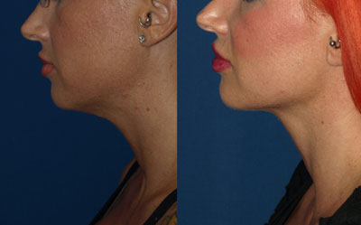 Necklift Before and After Photos San Diego