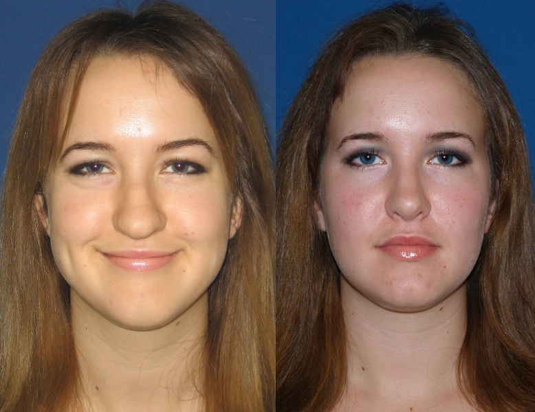 Allison Raskin Nose Job