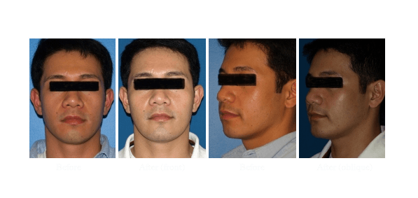 cheekbone implants men before and after