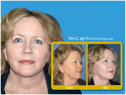Mini facelift patient in San Diego displaying before and after photos