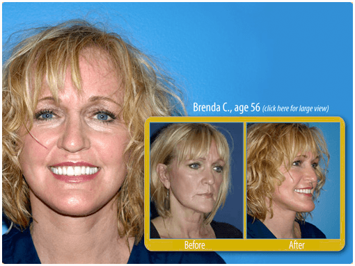 mini facelift before and after photo