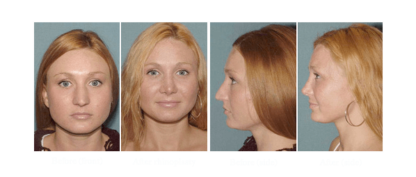 Before and after photo of a patient that opted for rhinoplasty surgery in San Diego