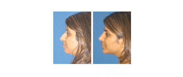 Nose surgery before and after photos of patient from La Jolla Ca