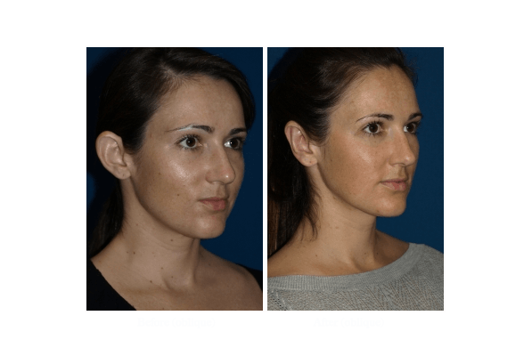 Otoplasty La jolla