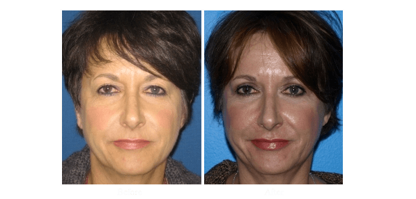 Blepharoplasty patient that opted for eyelid surgery