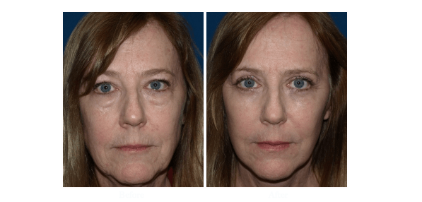 Eyelid surgery patient before and after photo - worked performed by Dr Roy David