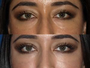 eyes before and after vertical