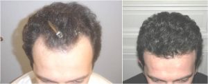 hairline 2 before and after