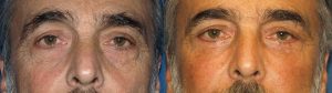 male fat transfer after rhinoplasty