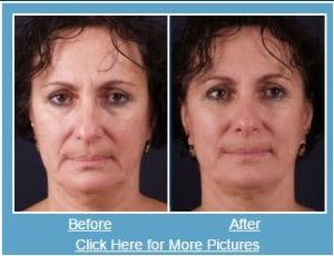 exilis before and after