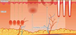 infini_Tissue_tech_compare