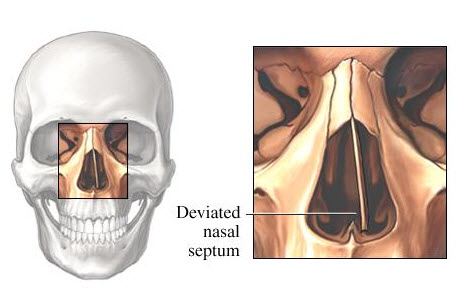 deviated septum image