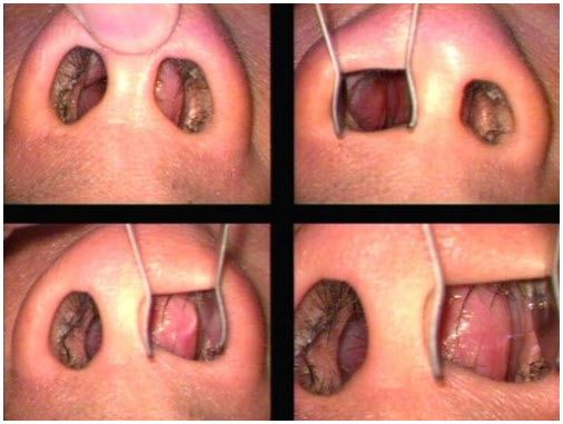 deviated septum repair