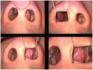 deviated septum repair