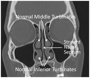 normal turbinate