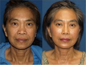 asian rhinoplasty