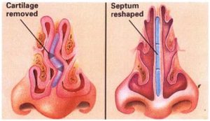 septoplasty image