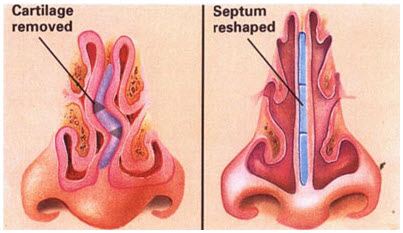 septoplasty image