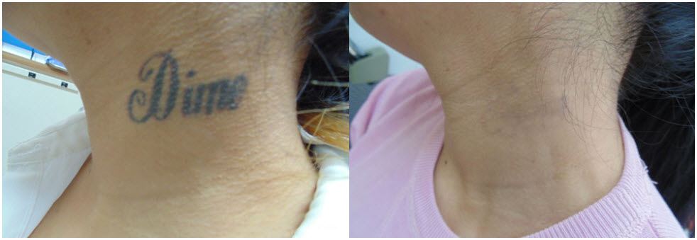 Laser Tattoo Removal San Diego CA  La Jolla Tattoo Remvoval