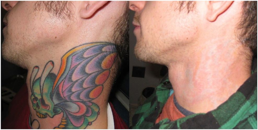 tattoo removal - San Diego Facelift & Rhinoplasty Roy David MD Facial  Plastic Surgeon