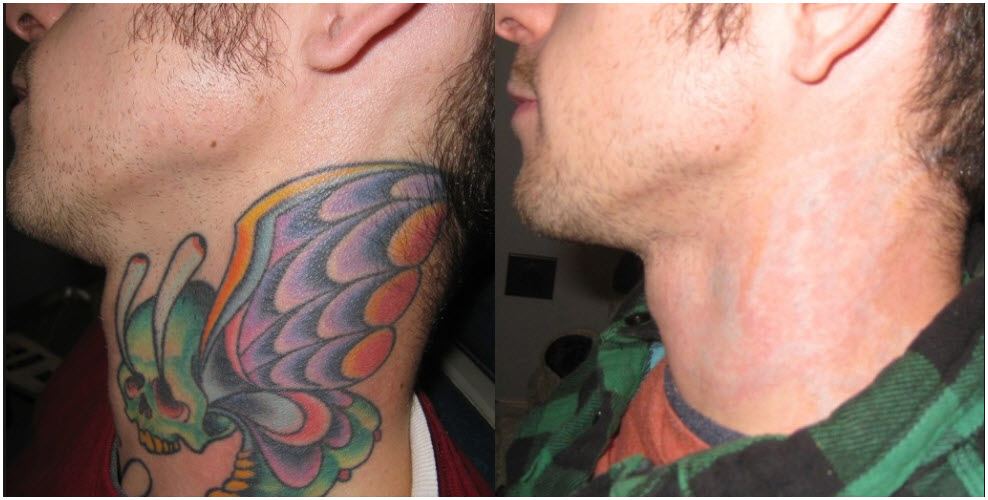 Laser Tattoo Removal in Dallas - Lemmon Avenue