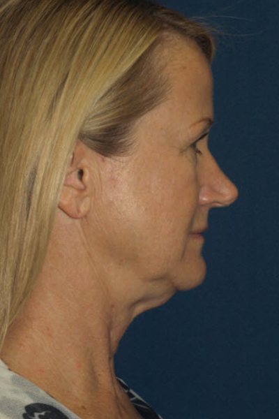 Patient 1 Before Image