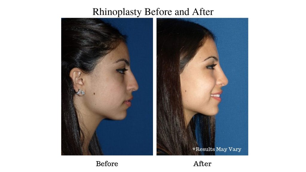 Austin Rhinoplasty Surgery