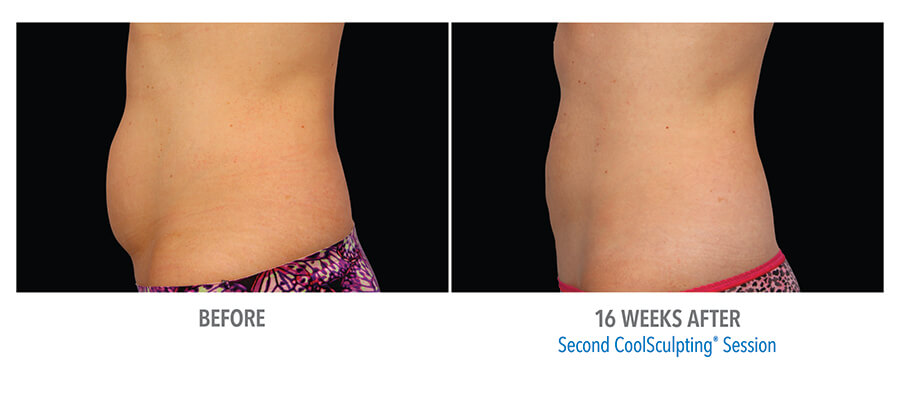 1 CoolSculpting Medical Spa, San Diego, CA