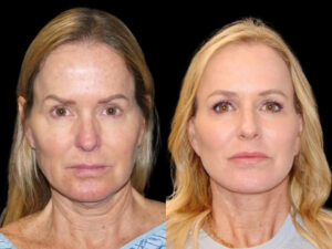 Deep Plane Facelift Patient Results 1