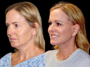 Deep Plane Facelift Patient Results 2