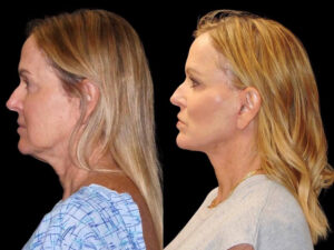 Deep Plane Facelift Patient Results 3