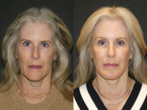 Deep Plane Facelift Patient Results 4