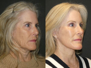 Deep Plane Facelift Patient Results 5