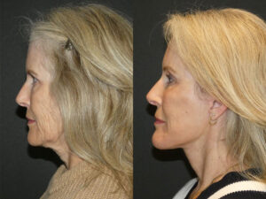 Deep Plane Facelift Patient Results 6