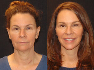 Deep Plane Facelift Patient Results 7