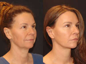 Deep Plane Facelift Patient Results 8