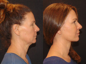 Deep Plane Facelift Patient Results 9