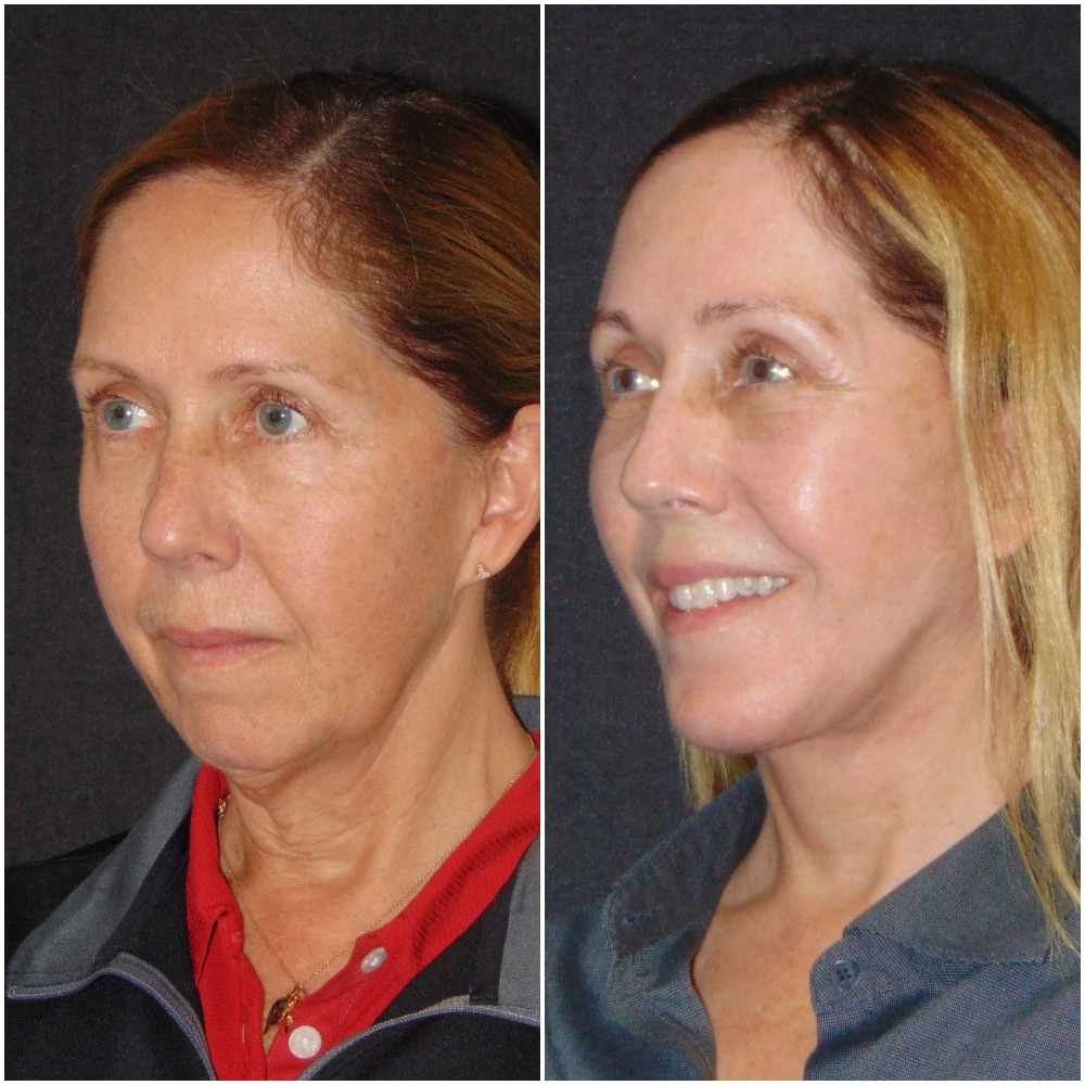 DEEP PLANE FACELIFT - Golden Triangle Plastic Surgery