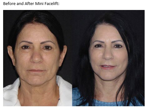 MINI FACELIFT VERSUS FULL FACELIFT - Golden Triangle Plastic Surgery