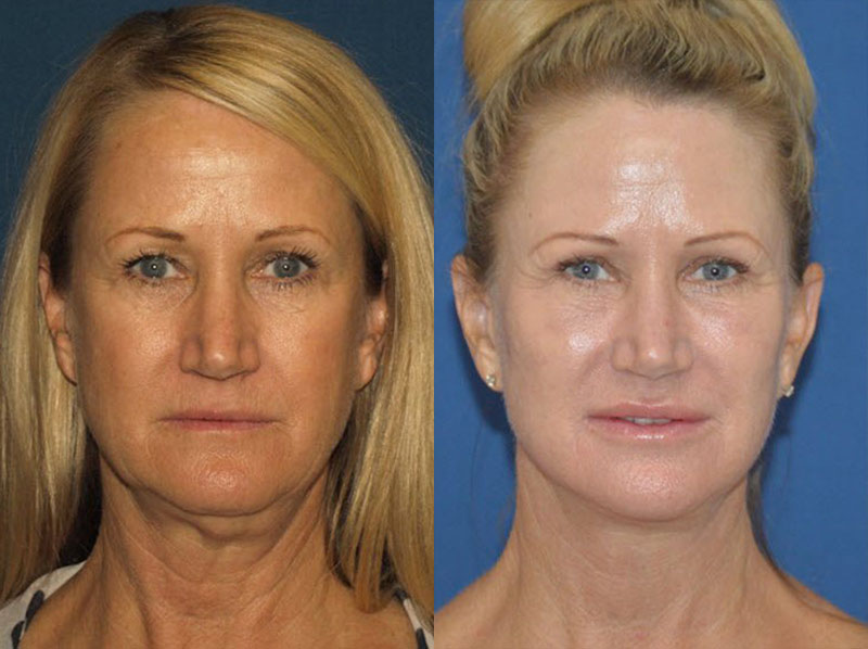 before-after