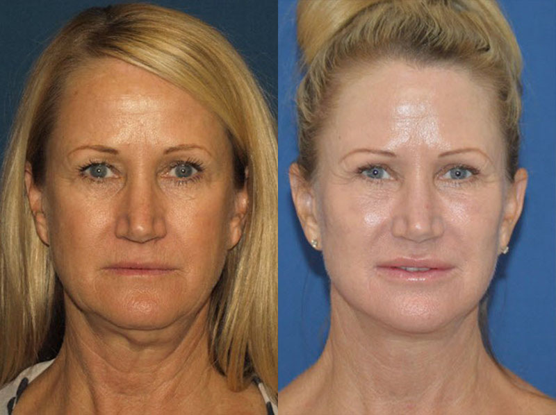 Facelift San Diego  San Diego Rhytidectomy