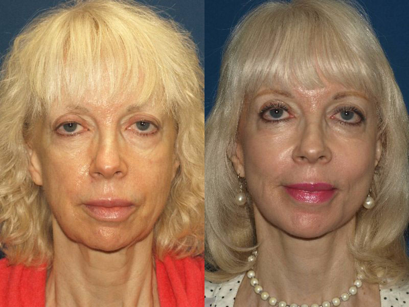 before-after