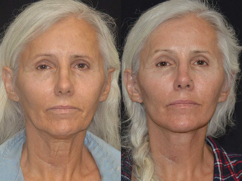 before-after