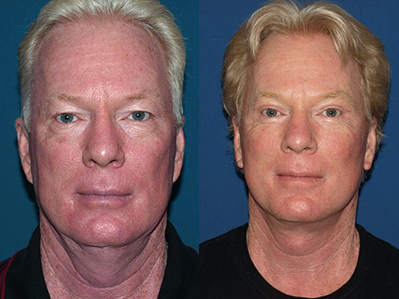 before-after
