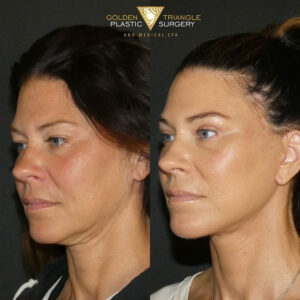 Before and after results