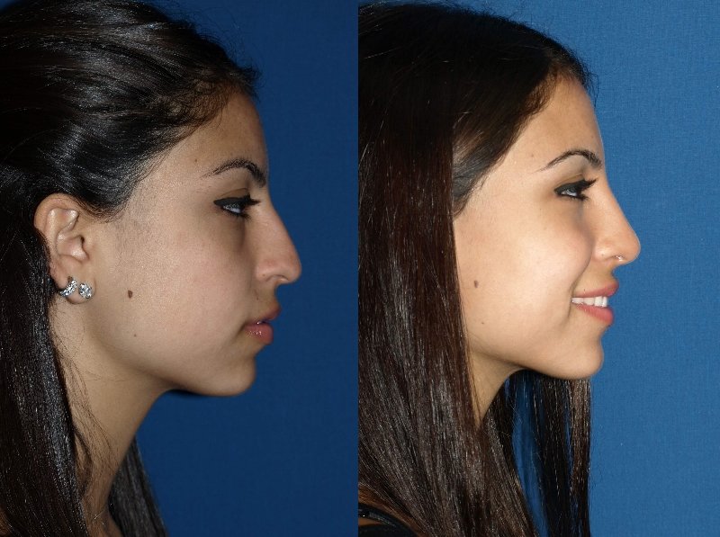 Before and after rhinoplasty photos provided by board certified facial plas...
